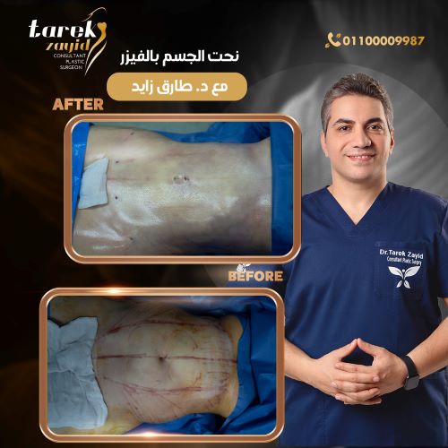 ما بعد شفط الدهون بالفيزر